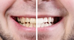 Stomatolozi otkrili najgore načine izbjeljivanja zubi